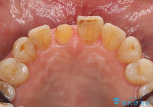 天然歯を模した ハイグレードオールセラミッククラウンの治療中