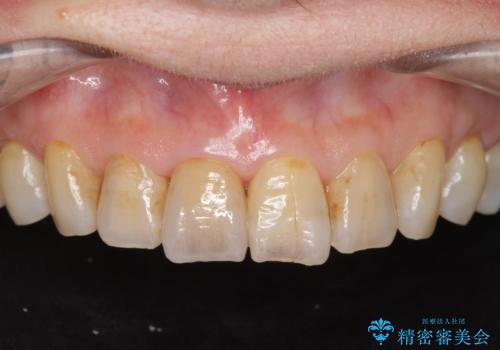天然歯を模した ハイグレードオールセラミッククラウンの治療後