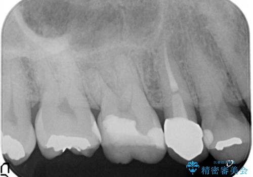 奥歯の根管治療~オールセラミッククラウンの治療前