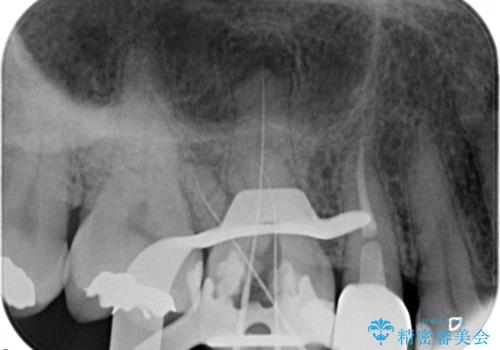 奥歯の根管治療~オールセラミッククラウンの治療中