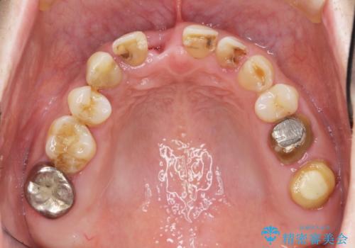 咬合性外傷による歯槽骨吸収　ブリッジ補綴の症例 治療前