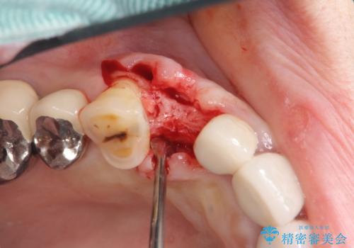 クラウン下に再発した深い虫歯 インプラントによる機能回復の治療中
