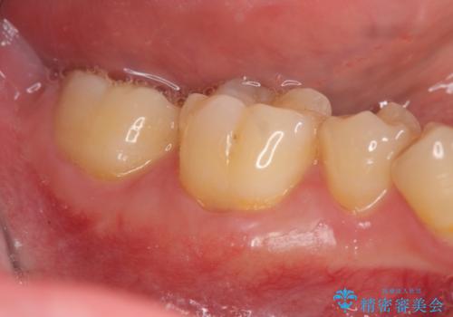 歯ぐきが下がり歯がしみる　歯肉移植による治療の治療後