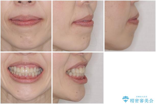 この際全てをしっかりと治療したい 総合歯科治療の治療前(顔貌)