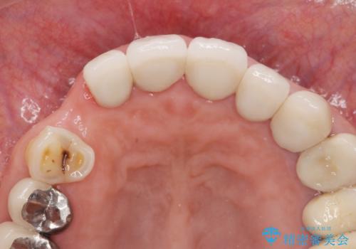 クラウン下に再発した深い虫歯　インプラントによる機能回復の治療前