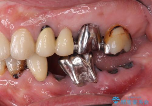 虫歯による歯の喪失　インプラントによる咬合機能回復の症例 治療前
