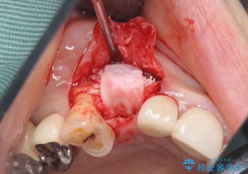 クラウン下に再発した深い虫歯　インプラントによる機能回復の治療中