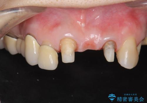 前歯ブリッジのやりかえの治療中