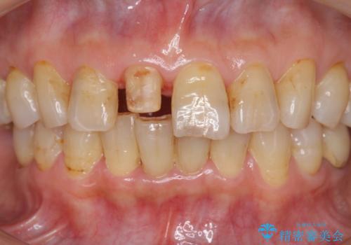 天然歯を模した ハイグレードオールセラミッククラウンの治療中