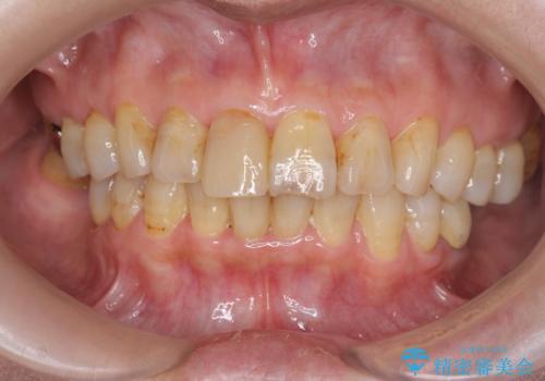 天然歯を模した ハイグレードオールセラミッククラウンの治療前