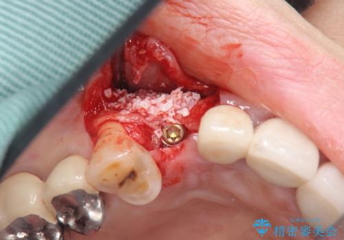 クラウン下に再発した深い虫歯　インプラントによる機能回復の治療中