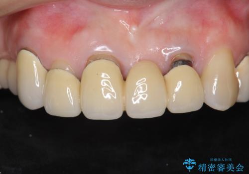 前歯ブリッジのやりかえの症例 治療前