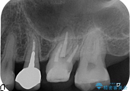 奥歯が痛い。根管治療~オールセラミッククラウンの治療の治療中