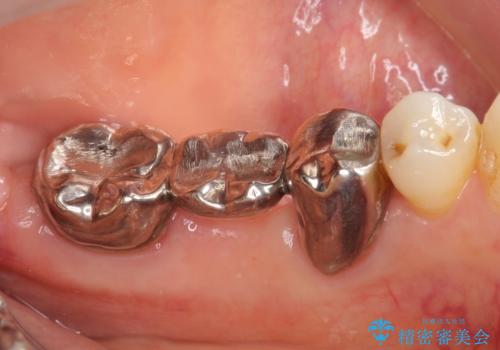 オールセラミッククラウン 欠損補綴と再生療法による深いポケットの改善の治療前