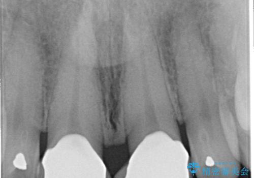 前歯のすきっぱ&奥歯の虫歯 セラミッククラウンで徹底的に治すの治療後