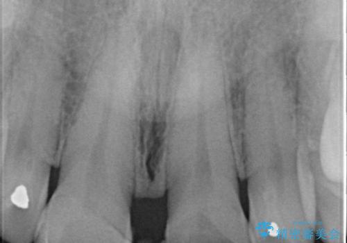 前歯のすきっぱ&奥歯の虫歯 セラミッククラウンで徹底的に治すの治療前