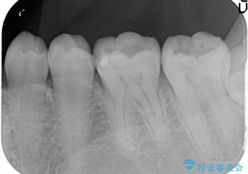 詰め物が外れた セラミックによる精密な修復の治療前