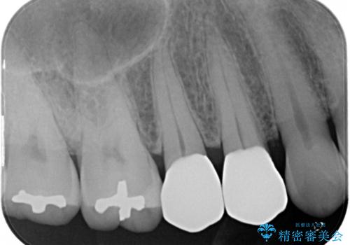 前歯のすきっぱ&奥歯の虫歯 セラミッククラウンで徹底的に治すの治療後