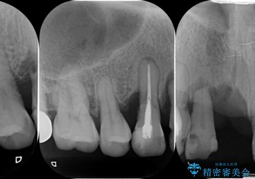 咬合性外傷による歯槽骨吸収 ブリッジ補綴の治療前