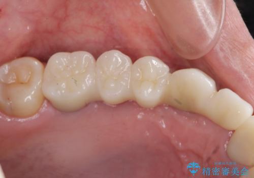 虫歯による多数歯欠損　インプラント咬合機能回復の治療後