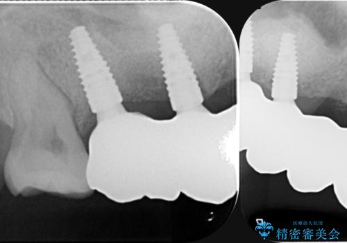 虫歯による多数歯欠損 インプラント咬合機能回復の治療後