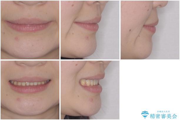 前歯のデコボコを治したい インビザラインによる矯正治療の治療後(顔貌)