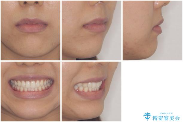 ディープバイトと前歯のデコボコを治したい インビザラインによる矯正治療の治療後(顔貌)