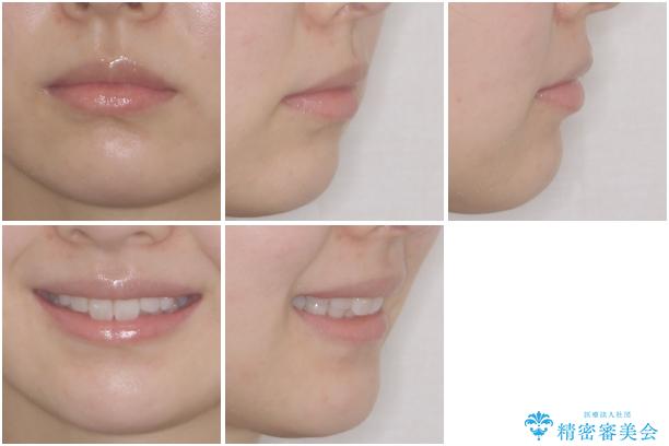 矯正治療の後戻り インビザラインによる再矯正治療の治療後(顔貌)