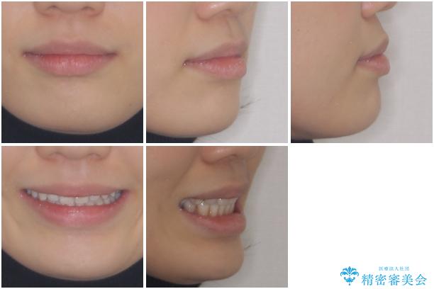 話しにくいオープンバイト インビザラインによる矯正治療の治療後(顔貌)