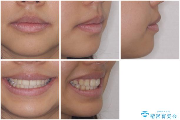 口が閉じられない 抜歯矯正で口元をスッキリとの治療後(顔貌)