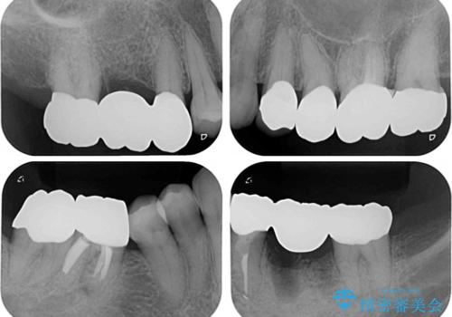 金属を全てセラミックに メタルフリー治療の治療後