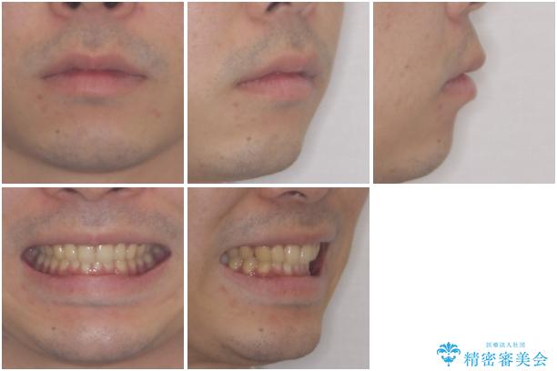 深い咬み合わせと前歯のデコボコの改善 インビザラインによる矯正治療の治療後(顔貌)