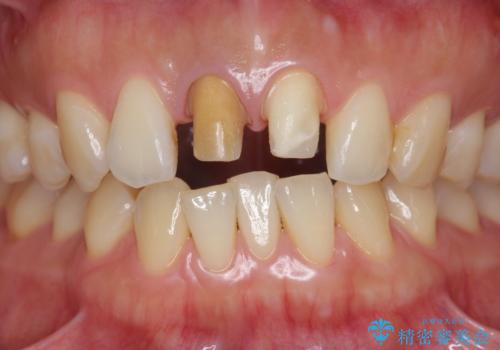 前歯の変色 根管治療と高品質セラミック歯科治療の治療中