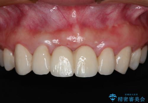 前歯 ブリッジ周囲の腫れた歯ぐきを改善の症例 治療後