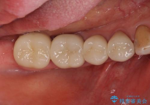 大臼歯 再根管治療の治療後