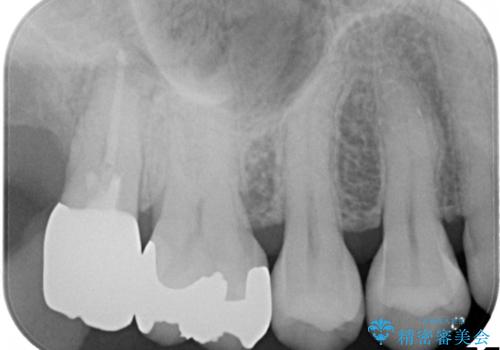 虫歯の治療 オールセラミッククラウンの治療後
