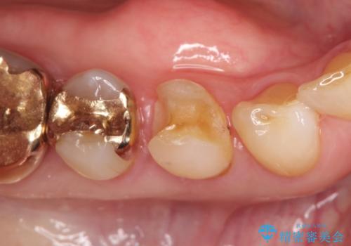 金属の詰め物が外れた。の治療前