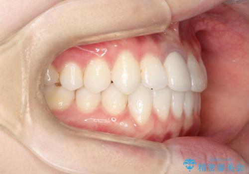 インビザライン 自信をもって笑えるようになりました。の治療後