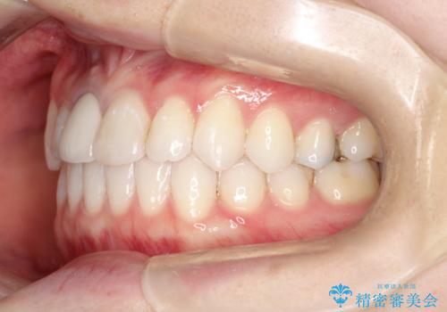 インビザライン 自信をもって笑えるようになりました。の治療後