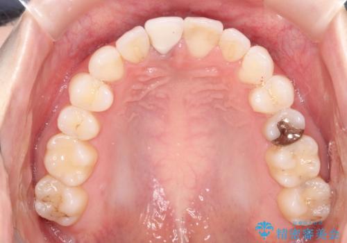 インビザライン 自信をもって笑えるようになりました。の治療後