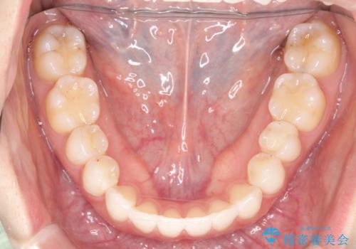 インビザライン 自信をもって笑えるようになりました。の治療後