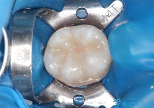 メタルフリー セラミックインレーによる治療の治療中