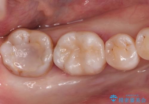 メタルフリー セラミックインレーによる治療の治療後