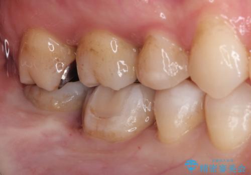 メタルフリー セラミックインレーによる治療の治療後