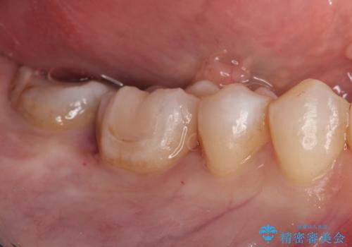 メタルフリー セラミックインレーによる治療の治療後