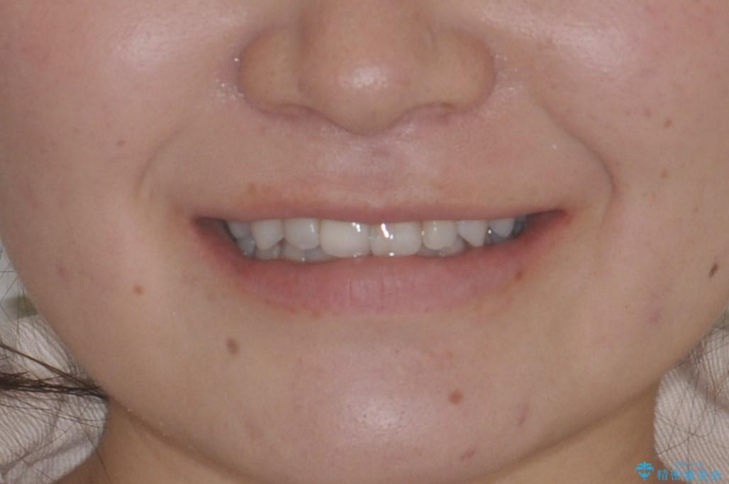 インビザライン 自信をもって笑えるようになりました。の治療後(顔貌)