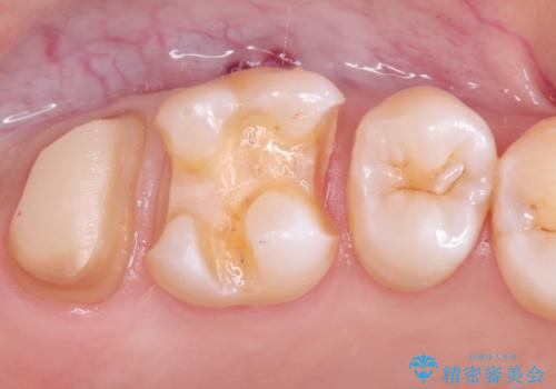 虫歯の治療 オールセラミッククラウンの治療中