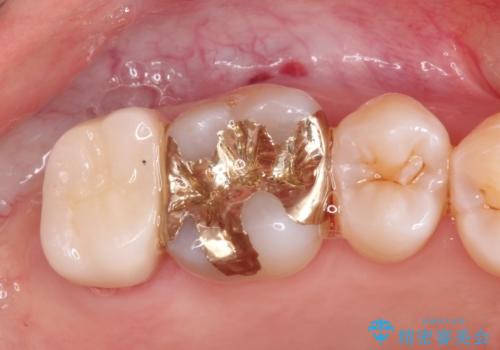 虫歯の治療 オールセラミッククラウンの症例 治療後