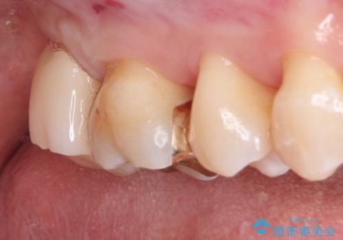 虫歯の治療 オールセラミッククラウンの治療後