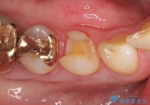 金属の詰め物が外れた。の治療中